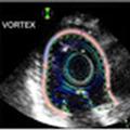 Engineers develop novel ultrasound technology to screen for heart conditions