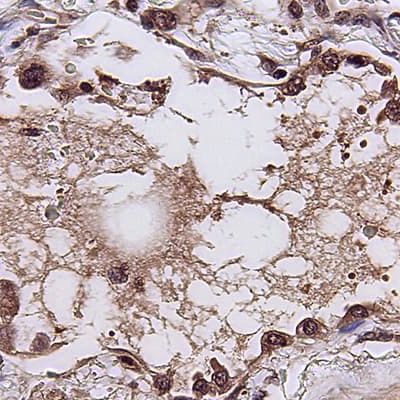 AI predicts how patients with viral infections, including COVID-19, will fare